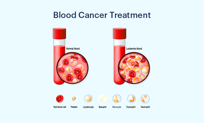 Blood Cancer treatment In Shadol